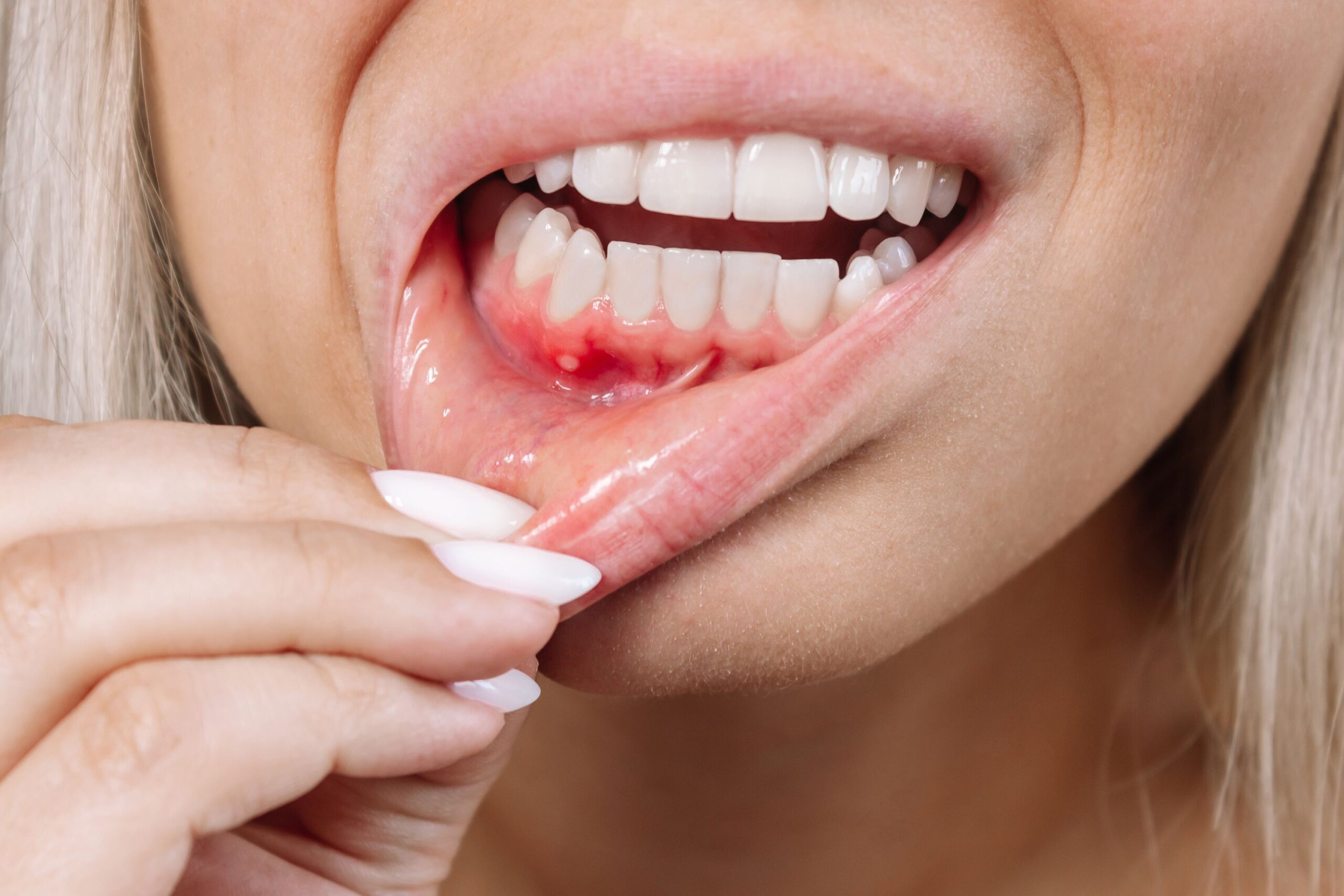 Close up van vrouwenmond met tandvleesproblemen